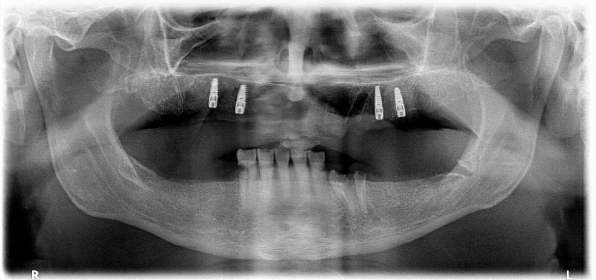 Bar-retained implant overdenture for treating edentulous maxilla
