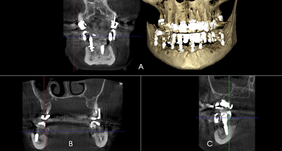 Peculiarities of Dental Implant Insertion in Complex Anatomical and Topographical Conditions of the Mandible by Immediate Implantation and Immediate Occlusal Loading