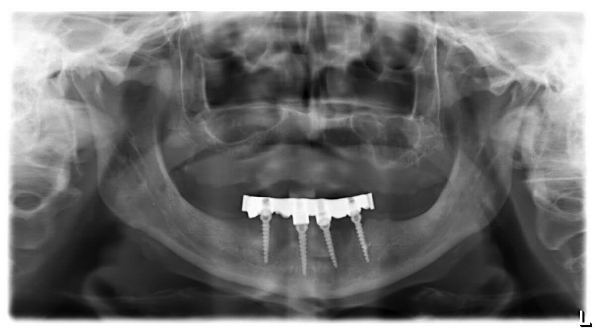 Treatment options with M implants